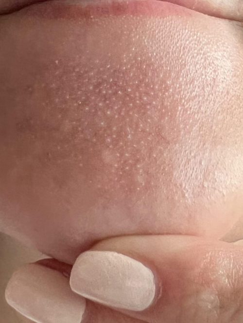 help-sebaceous-filaments-v0-vruga3v2vv391